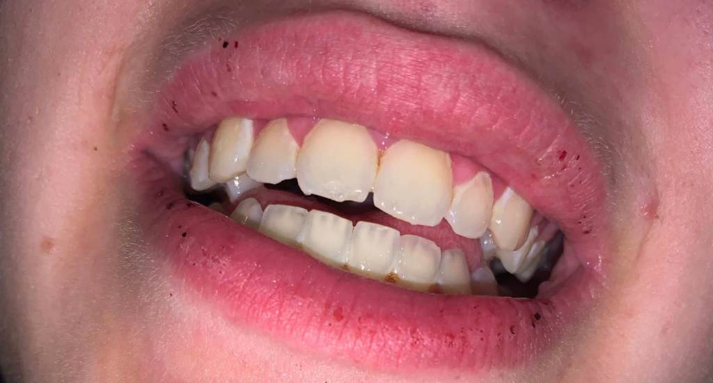 Antifa "broken teeth" attack hoax